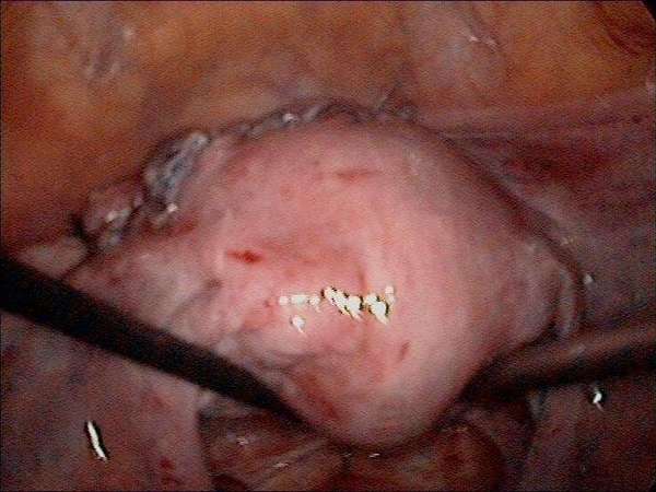 子宫肌瘤往宫腔里长必须手术吗子宫肌瘤往宫腔里长，必须手术吗？——深度解析治疗选择