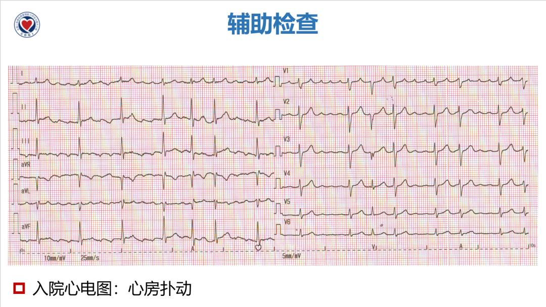 子宫肌瘤会引起心包积液吗子宫肌瘤会引起心包积液吗，深度解析